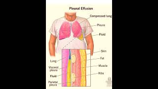 Pleural effusion Lungs disorderchati me pani hona छाती में पानी होनाbiology anatomyicunursing [upl. by Yecad]