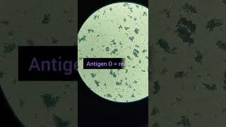 Widal test typhoid  Widal test procedure  How to check positive amp Negative test labtechnician [upl. by Millman]