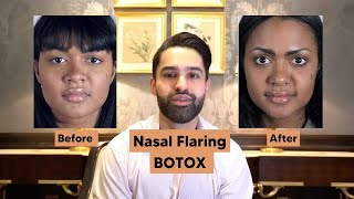 Botox For Nasal Flaring [upl. by Guzel681]