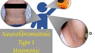 Neurofibromatosis Type 1 Mnemonic  Signs of NF1 [upl. by Notkcorb]