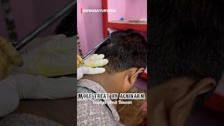 Mole treatment by Bams Student shorts agnikarma [upl. by Clerissa]