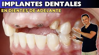 Caso complicado de Implantes Dentales en dientes frontales Antes y después [upl. by Trellas]