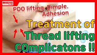 Treatment of Cog thread lifting complications  skin dimpling and adhesions live surgery video [upl. by Anerol]