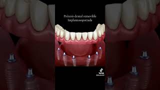 Prótesis dental removible implantosoportada saludbucal dentist ￼ [upl. by Oznole744]