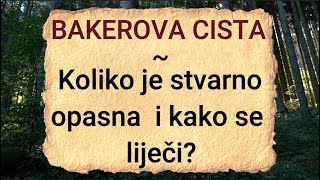 Bakerova cista poplitealna cista – Koliko je stvarno opasno ovo stanje i kako se liječi [upl. by Anoli]