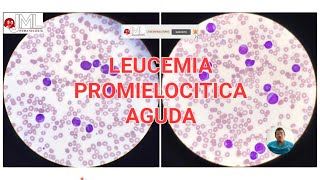 PROMIELOCITOS PATOLÓGICOS LEUCEMIA PROMIELOCÍTICA AGUDA MORFOLOGÍA [upl. by Regine]