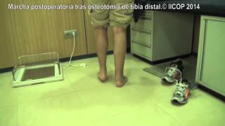 MARCHA POST OPERATORIA TRAS OSTEOTOMIA DE TIBIA DISTAL [upl. by Ylim]