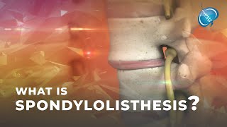 What is Spondylolisthesis  Vertebral Slippage [upl. by Assyla]