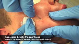 Subscision and surgery for acne scars [upl. by Cleodel111]