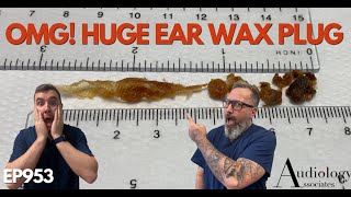 OMG HUGE EAR WAX PLUG REMOVED  EP953 [upl. by Keeler143]