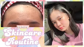 how to get rid of tiny bumps on forehead my skincare routine ❀  Philippines [upl. by Ayocat]