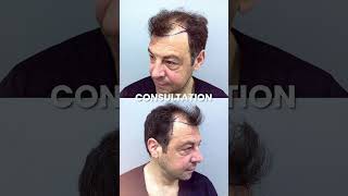 Dr Gökay Bilgin Evaluated Marcos 12 Months Hair Transplant Result [upl. by Astiram]