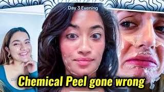 INFLUENCERS NEED TO STOP PROMITING CHEMICAL PEEL AS BEAUTY TREATMENT [upl. by Aihsinyt786]