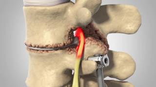 Adjacent Segment Disease  Patient Animation [upl. by Rramaj]