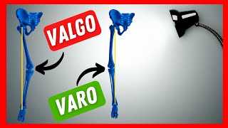 Ginocchio VARO e ginocchio VALGO  significato ed implicazioni 👈 [upl. by Donnie]