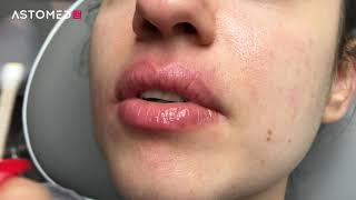 Ferulac Dubai Lips Peel  ASTOMED klinikutrustning [upl. by Strep]