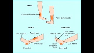 Ulcera cruris  Arterial amp Venous [upl. by Myrwyn]