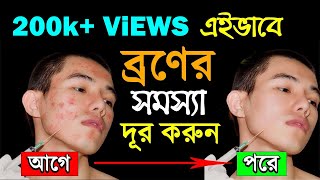 ব্রণ দূর করার উপায়  Mukher kalo dag dur korar upay  How to Remove Pimples or Acne [upl. by Analaf817]