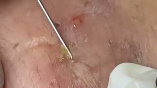 Ultimate Guide to Removing Blackheads and Whiteheads on Nose and Forehead 🌟 removeblackhead [upl. by Ecidnak]