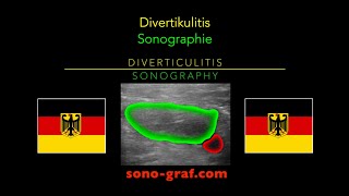 Sonographie  Divertikulitis [upl. by Eniruam252]