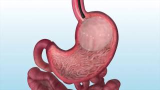 Endoscopic Therapy For Weight Loss Single Balloon Placement [upl. by Ahsote]