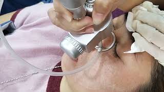 LASER CO2 FRACTIONAL TREATMENT [upl. by Arual597]