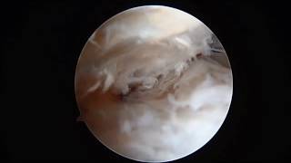 Posterior Ankle Arthroscopy with WIndowing for Excision of Os Trigonum SFISM [upl. by Elik]