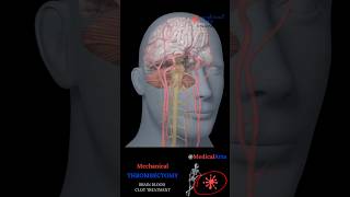 How Mechanical Thrombectomy Saves Stroke Patients Shorts [upl. by Eillo]