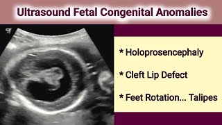 Ultrasound Fetal Holoprosencephaly [upl. by Blaise]