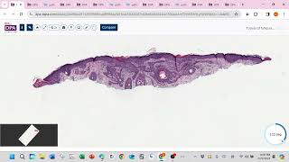 Tumor of follicular infundibulum [upl. by Drehcir]