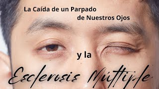 La Caída de un Parpado de Nuestros Ojos y la Esclerosis Múltiple esclerosismultiple ms [upl. by Weinman]