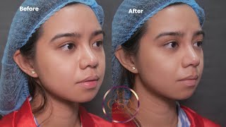 How to do repeat nose thread lift [upl. by Tasiana178]