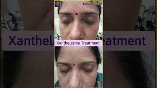 Xanthelasma removal treatment  Xanthelasma treatment laser  youtubeshort shorts xanthelasma [upl. by Chak]