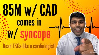 85M with CAD and prior coronary stenting comes in with syncope Check out this EKG [upl. by Crean885]