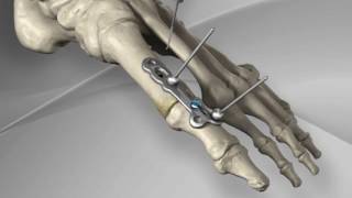 First Metatarsophalangeal Joint Fusion with Arthrex® MTP Fusion Plate [upl. by Heise]