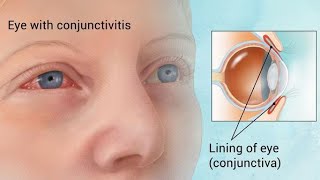 Conjunctivitis  Ophthalmology Videos [upl. by Baiss]