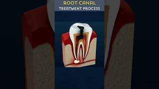 What REALLY Happens During a Root Canal [upl. by Seagraves]