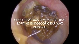 Cholesteatoma Revealed During Routine Endoscopic Wax Removal  Ep 07 [upl. by Halet781]