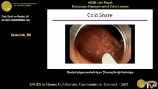 Standard polypectomy techniques Choosing the right technnique [upl. by Adnirak]