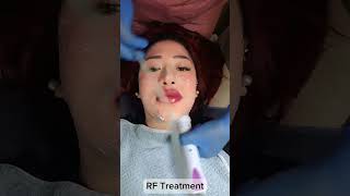 RF Treatment  HIFU Face Lift  HIKO Nose Lift  Microblading  Mesolipo  Lip Tattoo  Chin Filler [upl. by Arekahs346]