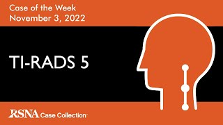 Case of the Week TIRADS 5 Papillary Thyroid Carcinoma [upl. by Trebliw]