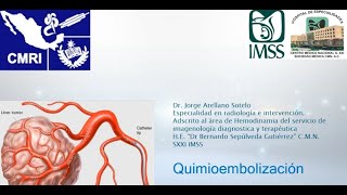 112 Actualidades en Quimioembolización de tumores hepáticos  Dr Arellano [upl. by Cam]