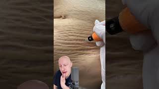 Plasma Pen As A Cure For Stretchmarks  Doctor Reacts [upl. by Kablesh]