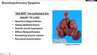 Virtual FTS Pediatric Session Bronchopulmonary Dysplasia [upl. by Rica]