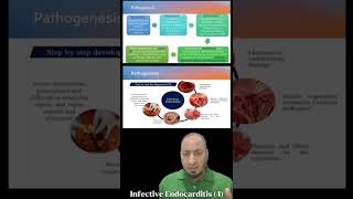 Infective Endocarditis 4 pathogenesis التهاب الشغاف المعدي microbiology medicalstudent [upl. by Hebe]