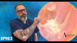 Most Satisfying Ear Wax And Thick Dead Skin Removal From Ear   EP982 [upl. by Beeson]