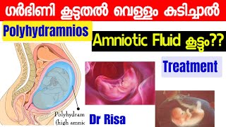 Pregnancy Complication Malayalam Polyhydramnios Amniotic fluid Normal level [upl. by Ahsienat941]