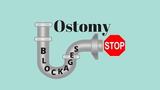 Dealing With Ostomy Blockages Ostomy Tips [upl. by Stent413]