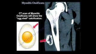 Myositis Ossificans  Everything You Need To Know  Dr Nabil Ebraheim [upl. by Amrita]