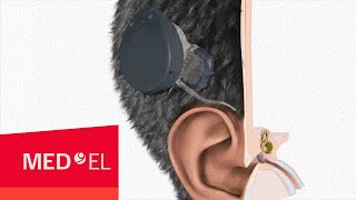 The RONDO cochlear implant from MEDEL  2D  INT [upl. by Corvin736]